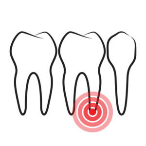 Root Canal Treatment New Orleans Louisiana